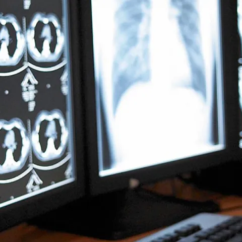 A series of medical charts on a projector